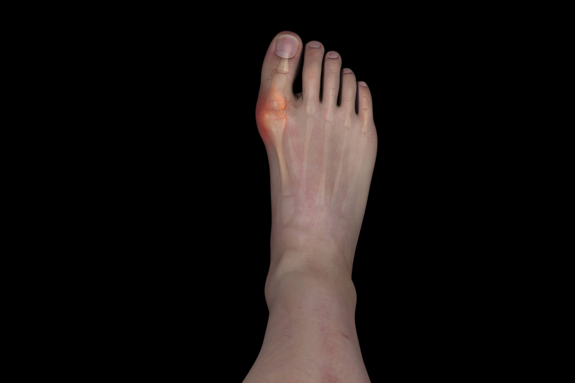 Bunion Hallux Valgus