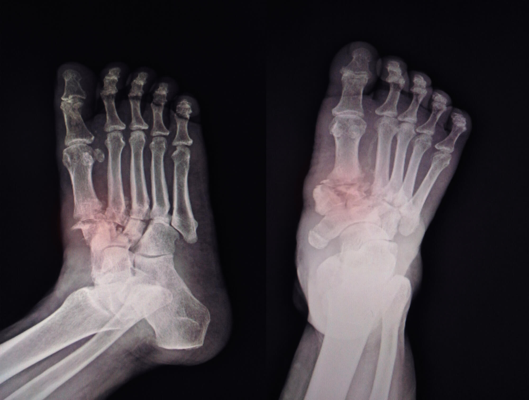 Foot Fracture