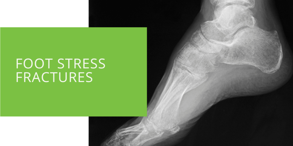 Foot Stress Fractures