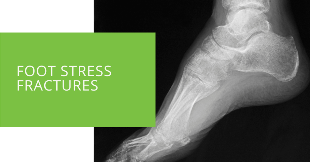 Foot Stress Fractures