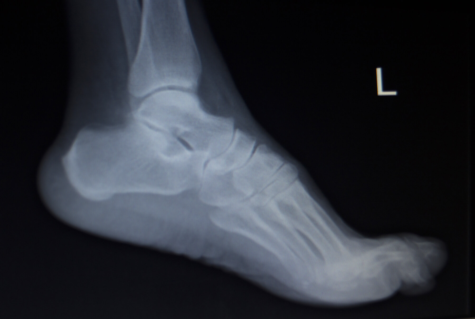 Foot X-ray