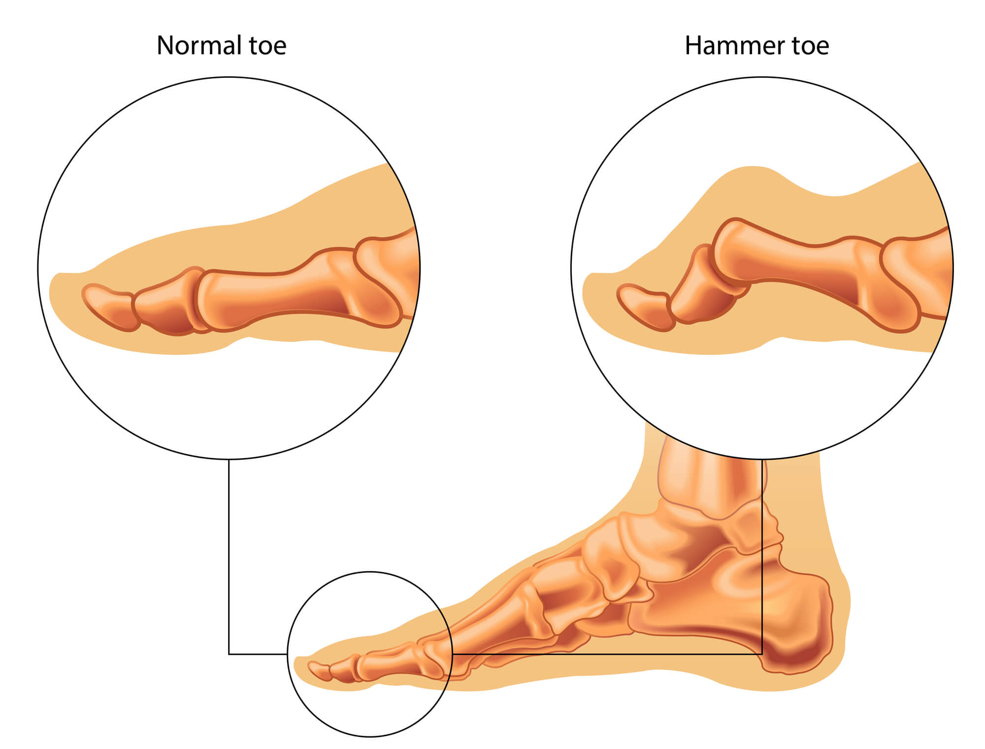 Hammertoe Illustration