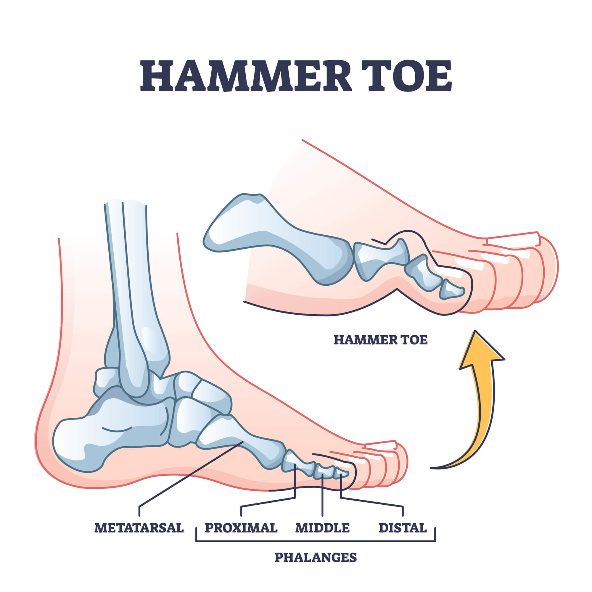 Hammertoe