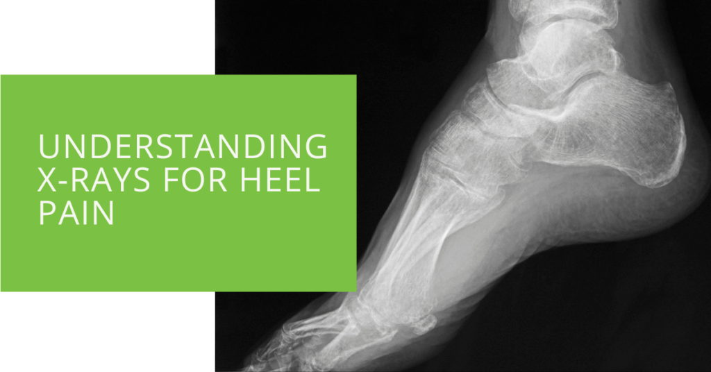 Understanding X-rays for Heel Pain