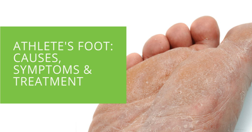 Athlete's Foot Causes, Symptoms & Treatment