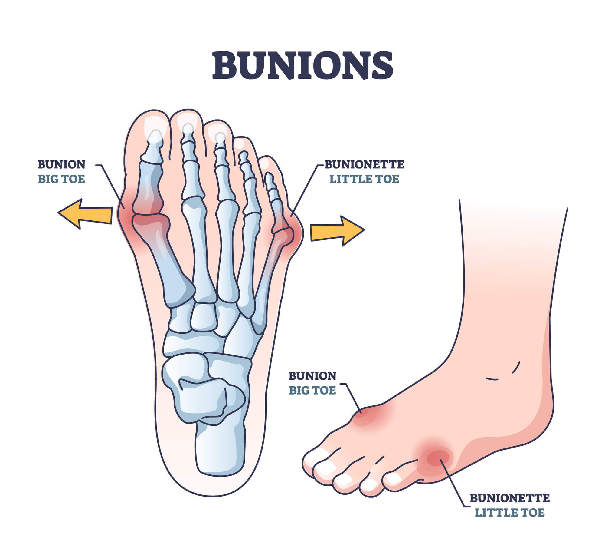 Bunions and bunionette