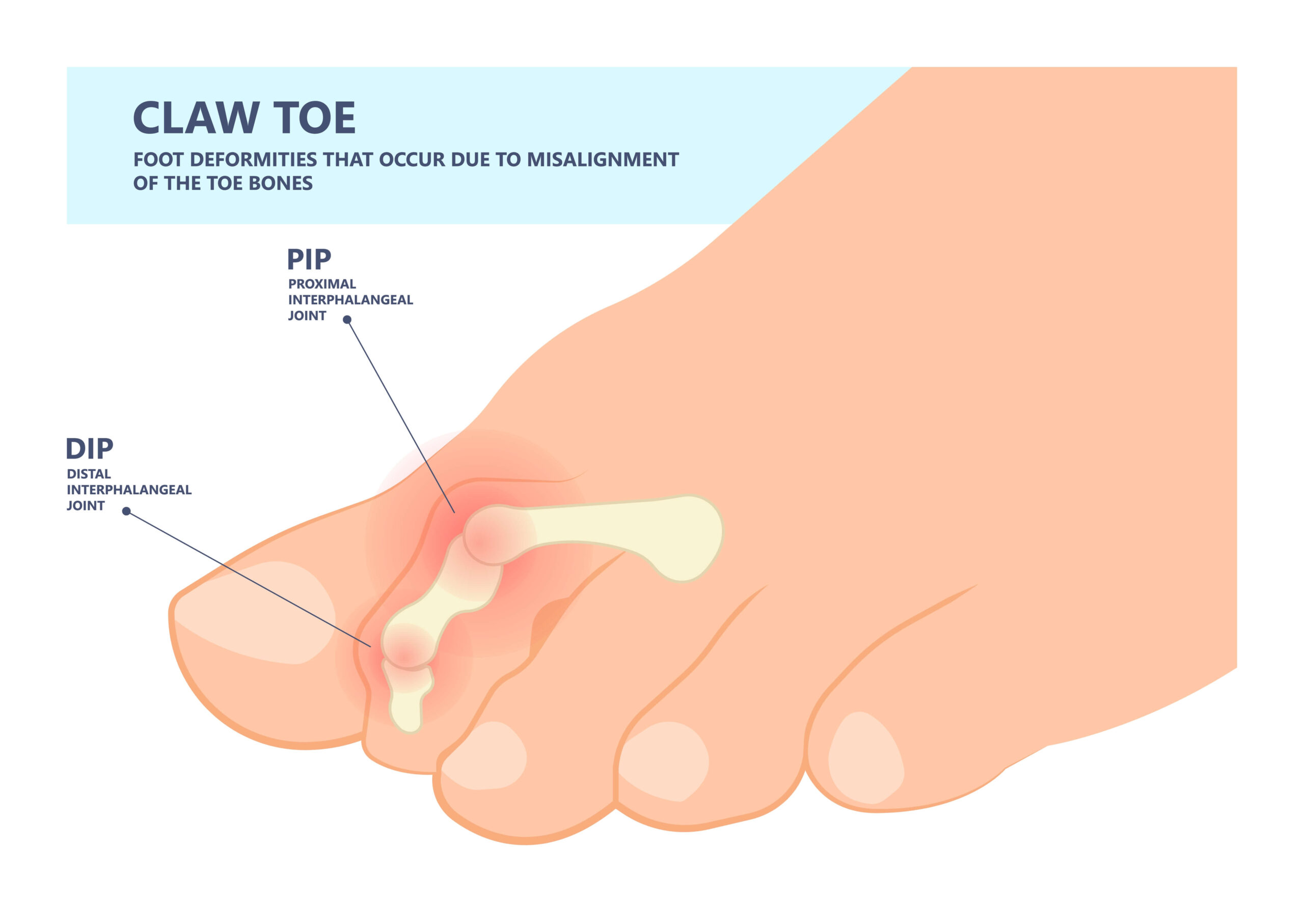 Claw Toe