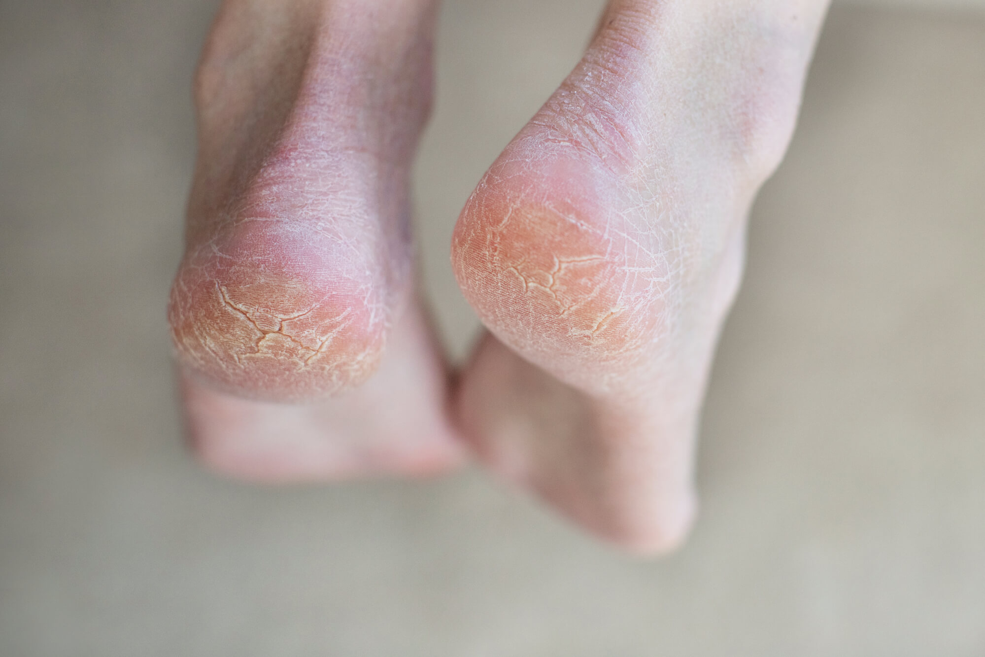 Treating Cracked Heels and Heel Fissures | Martin Foot & Ankle