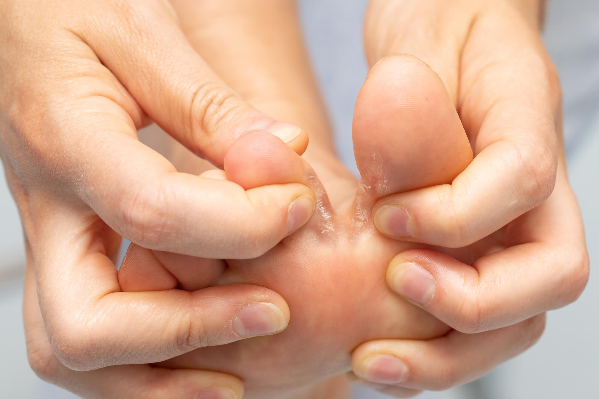 Closeup of Athlete's Foot