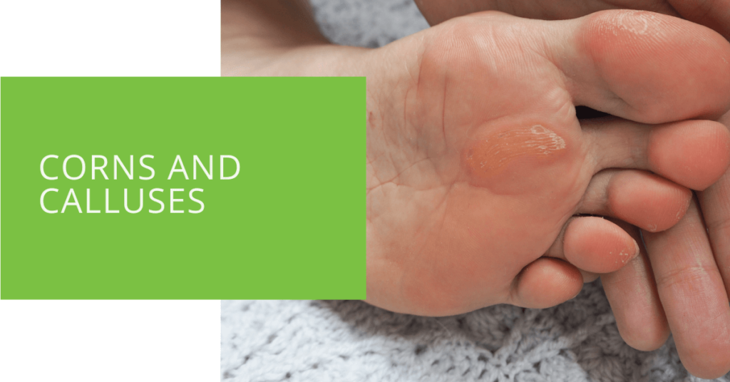 Corns and Calluses