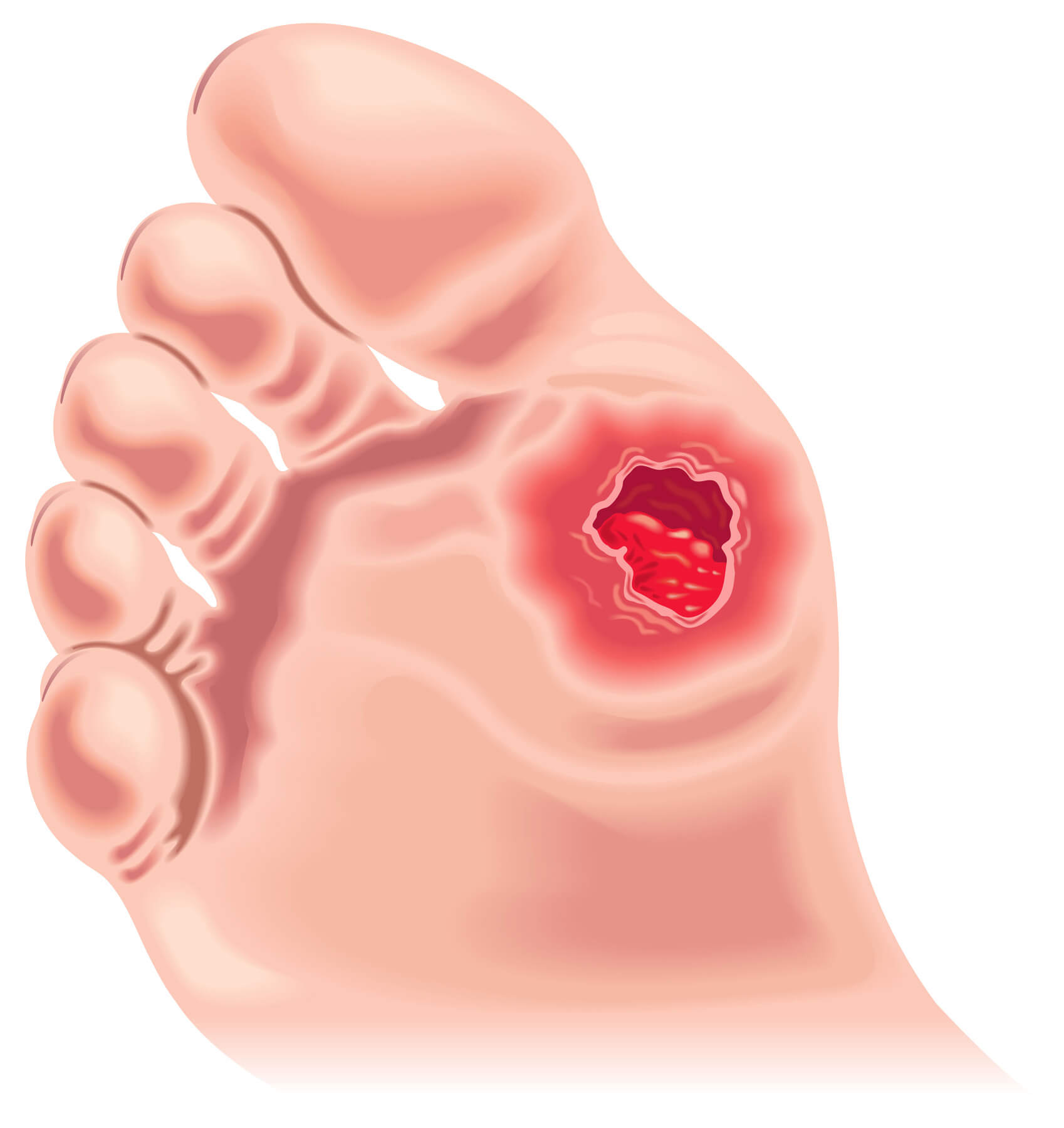 Diabetic Foot