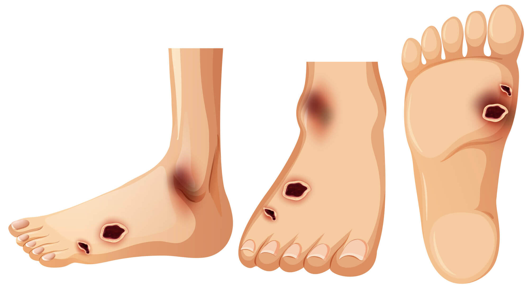 Diabetic feet