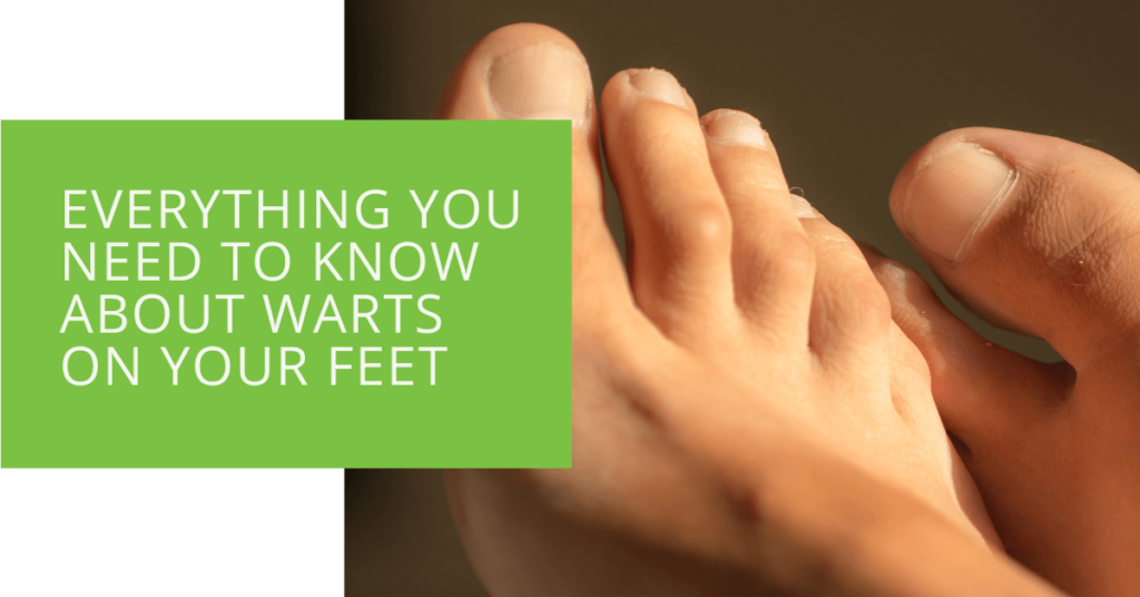 Everything You Need to Know About Warts on Your Feet