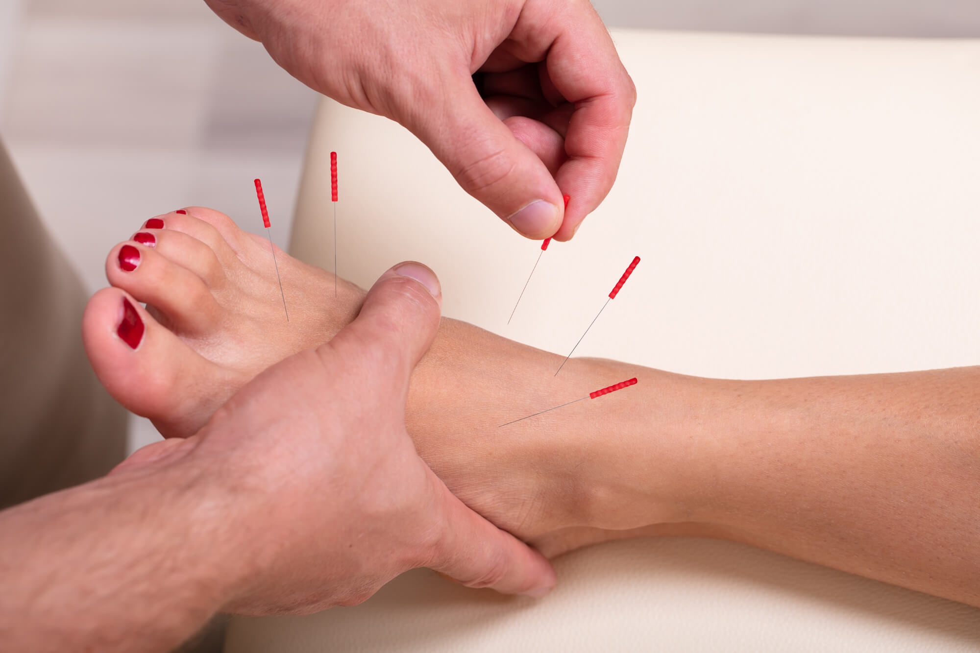 Dry Needling & Manipulation to Treat & Cure Plantar Fasciitis & Foot Pain