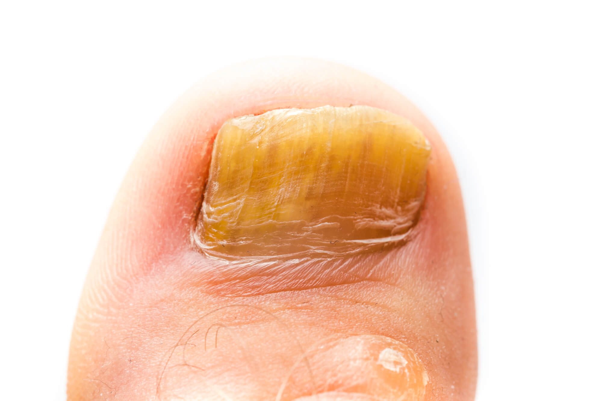 Fungus infection on nails