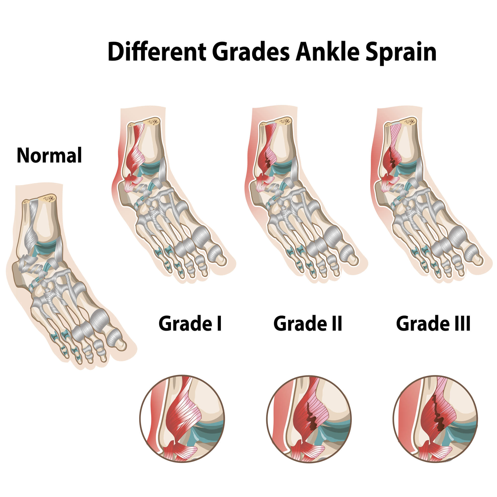 Grades of Ankle Sprains