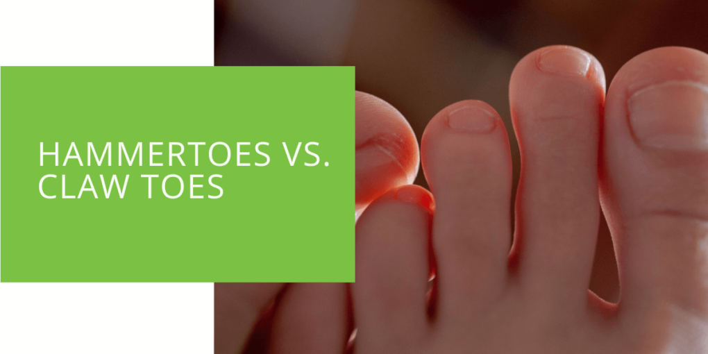 Hammertoes vs. Claw Toes