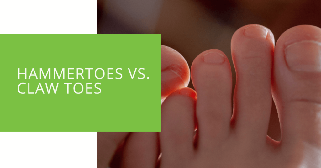 Hammertoes vs. Claw Toes