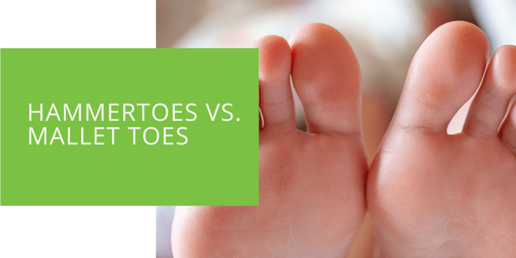Hammertoes vs. Mallet Toes