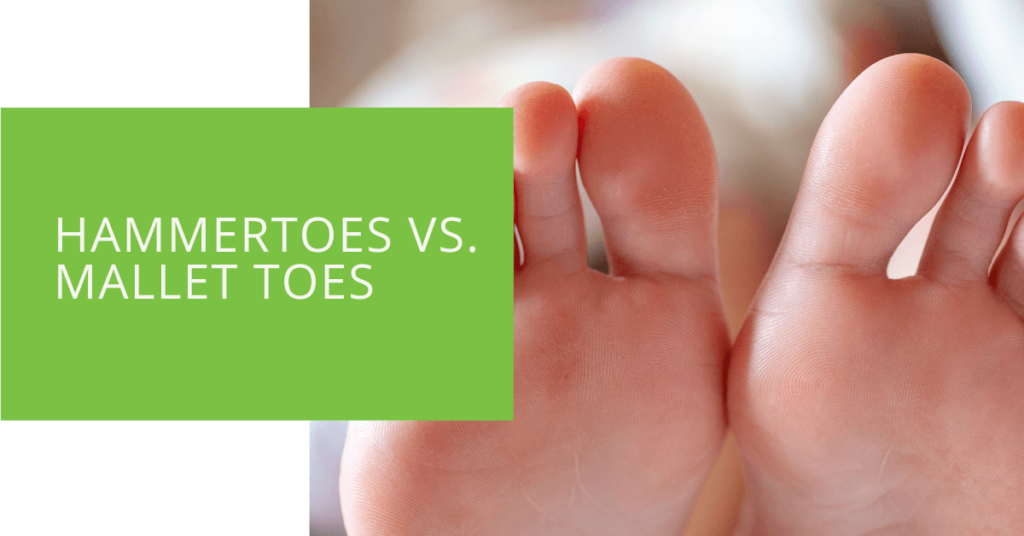 Hammertoes vs. Mallet Toes
