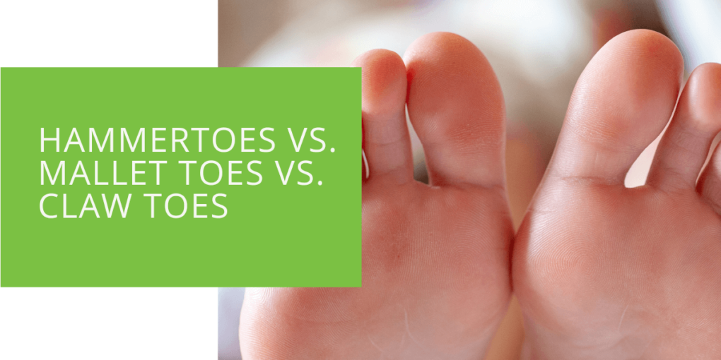 Hammertoes vs. Mallet Toes vs. Claw Toes