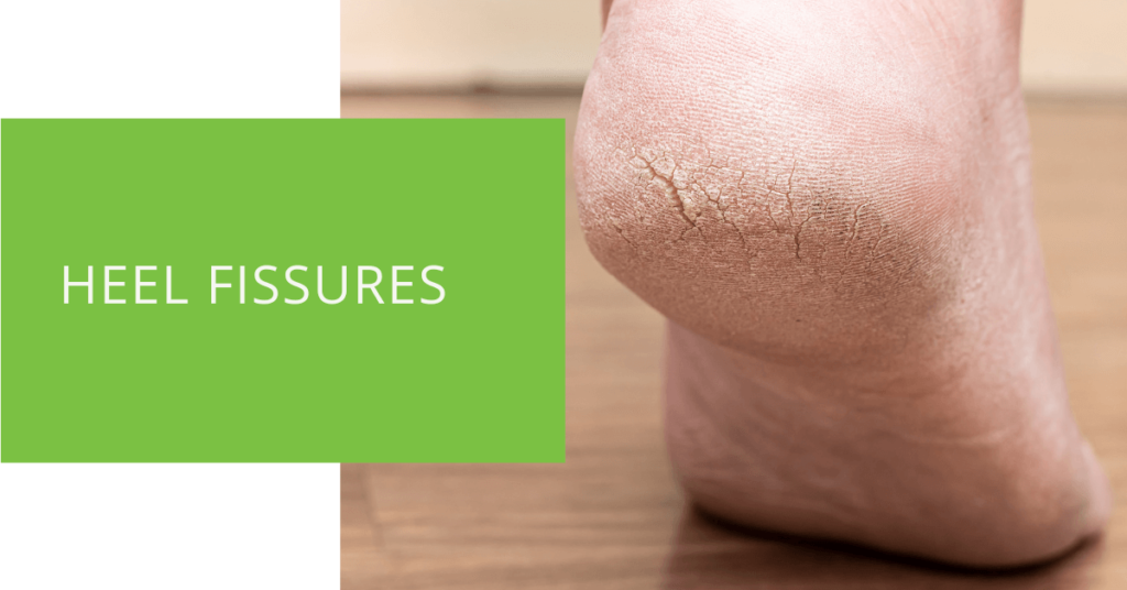 Heel Fissures