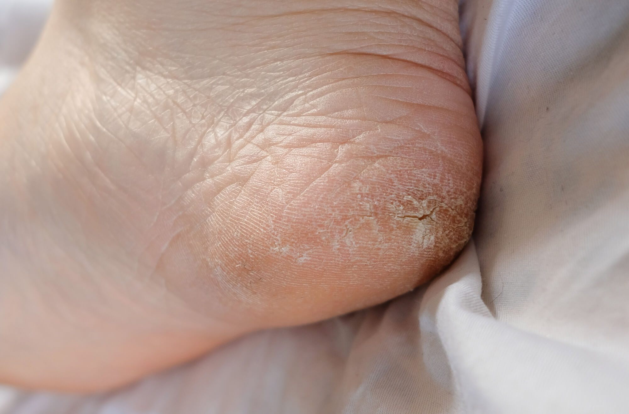 Heel Fissures - The Foot Care Group