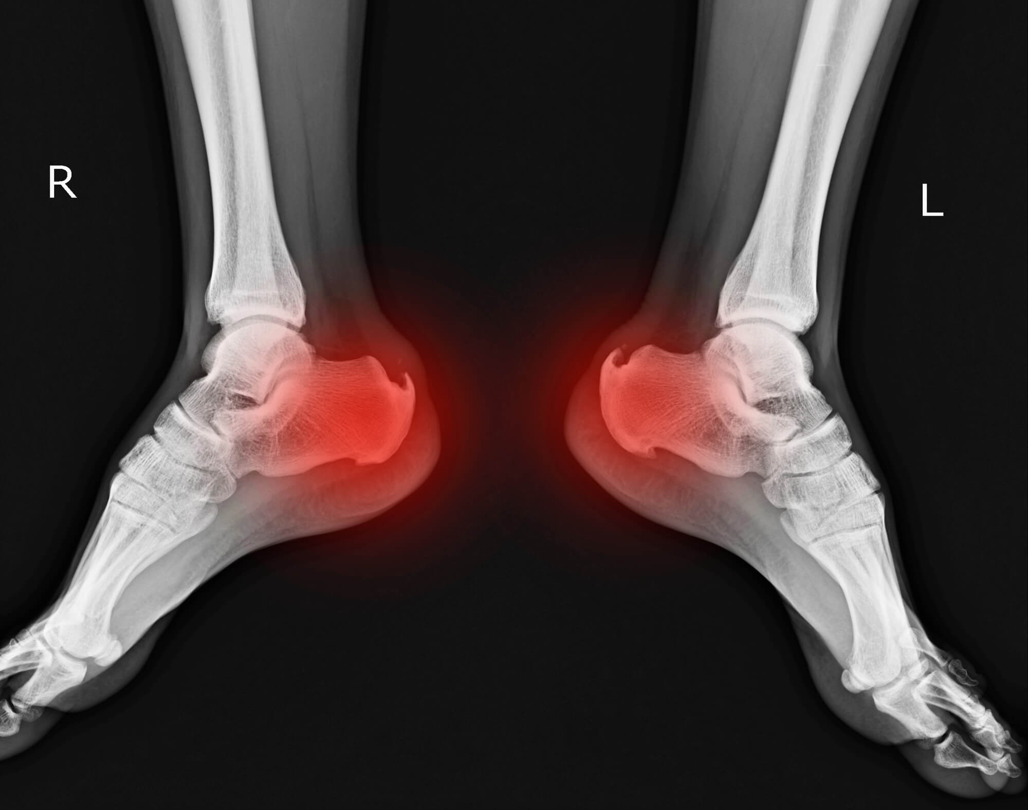 Heel Spur X-ray