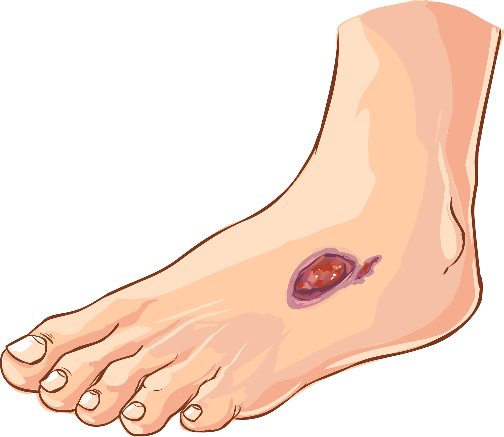 Illustration of Diabetic Foot