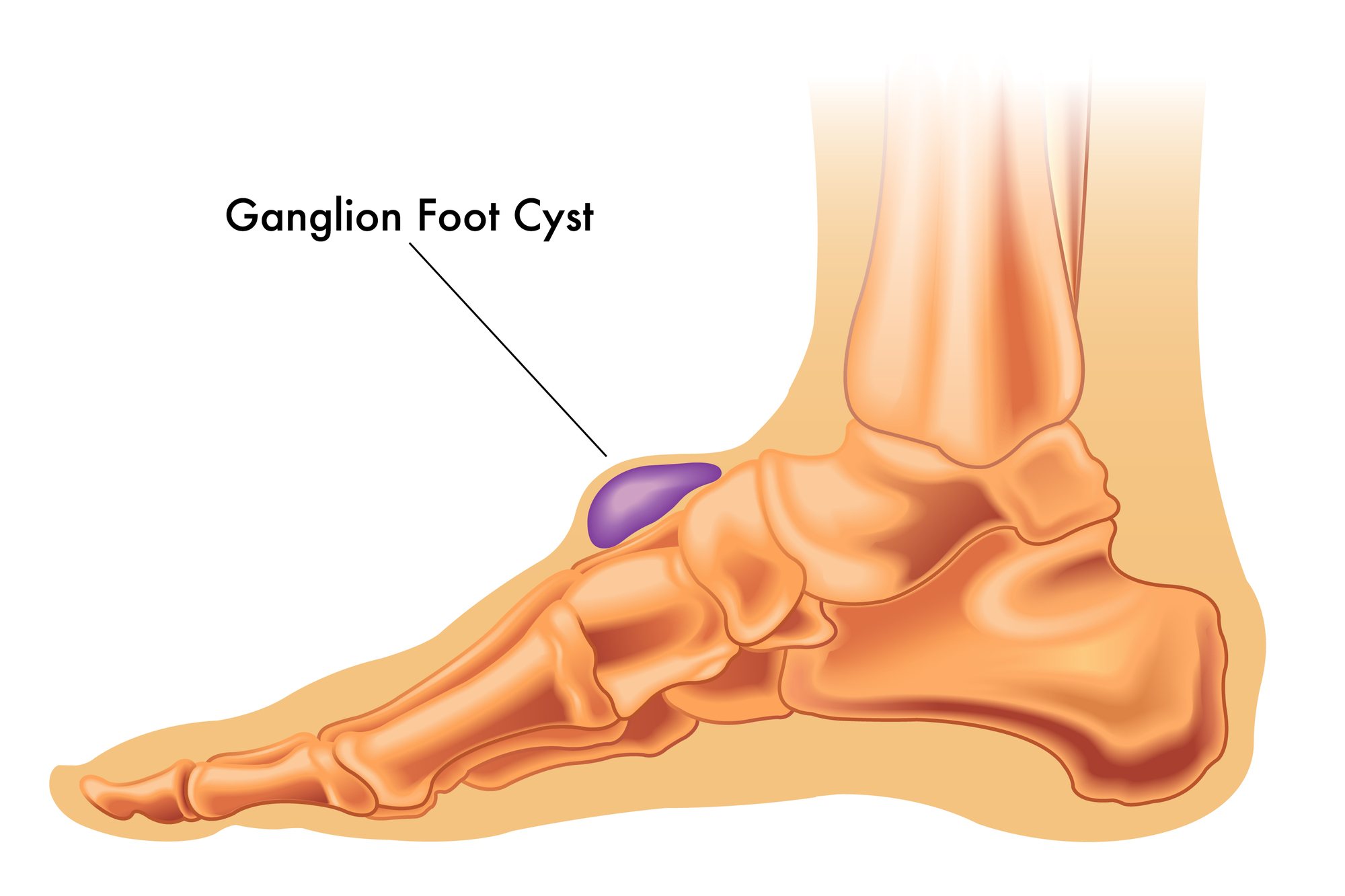 Illustration of a ganglion cyst on the foot