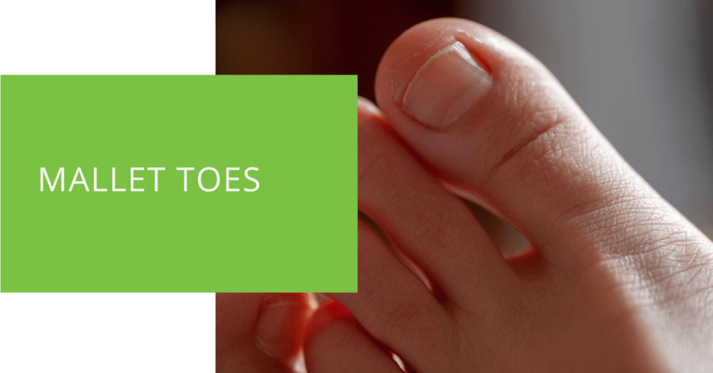 Mallet Toes
