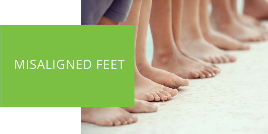 Misaligned Feet