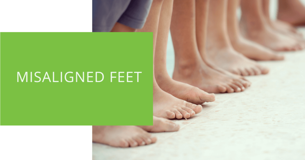 Misaligned Feet