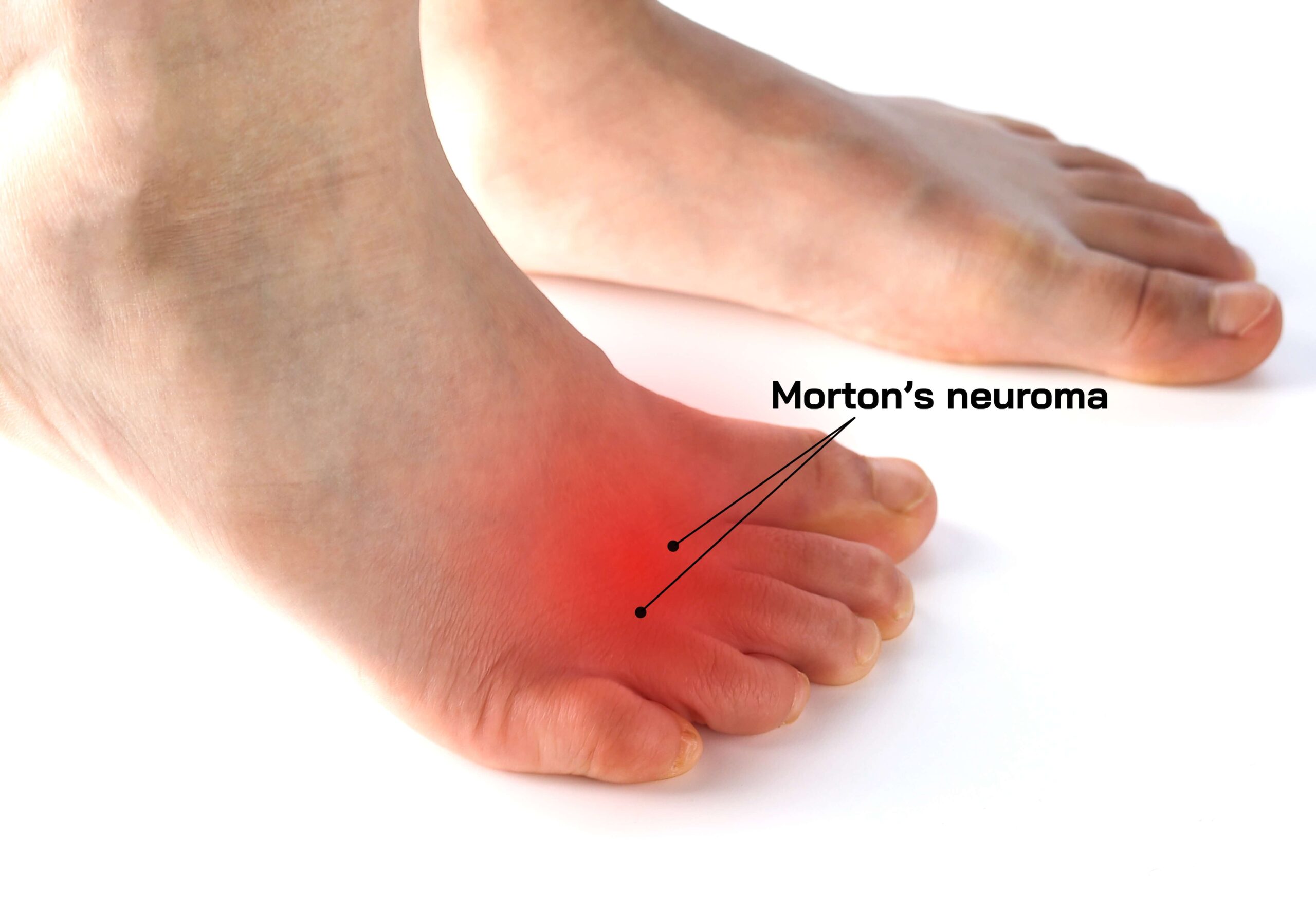 Morton's neuroma