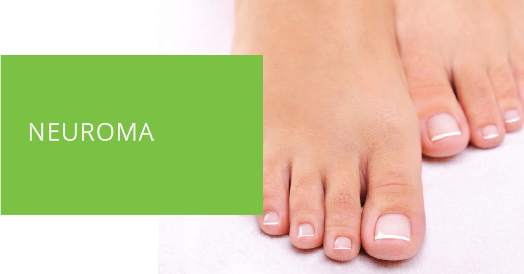 Neuroma