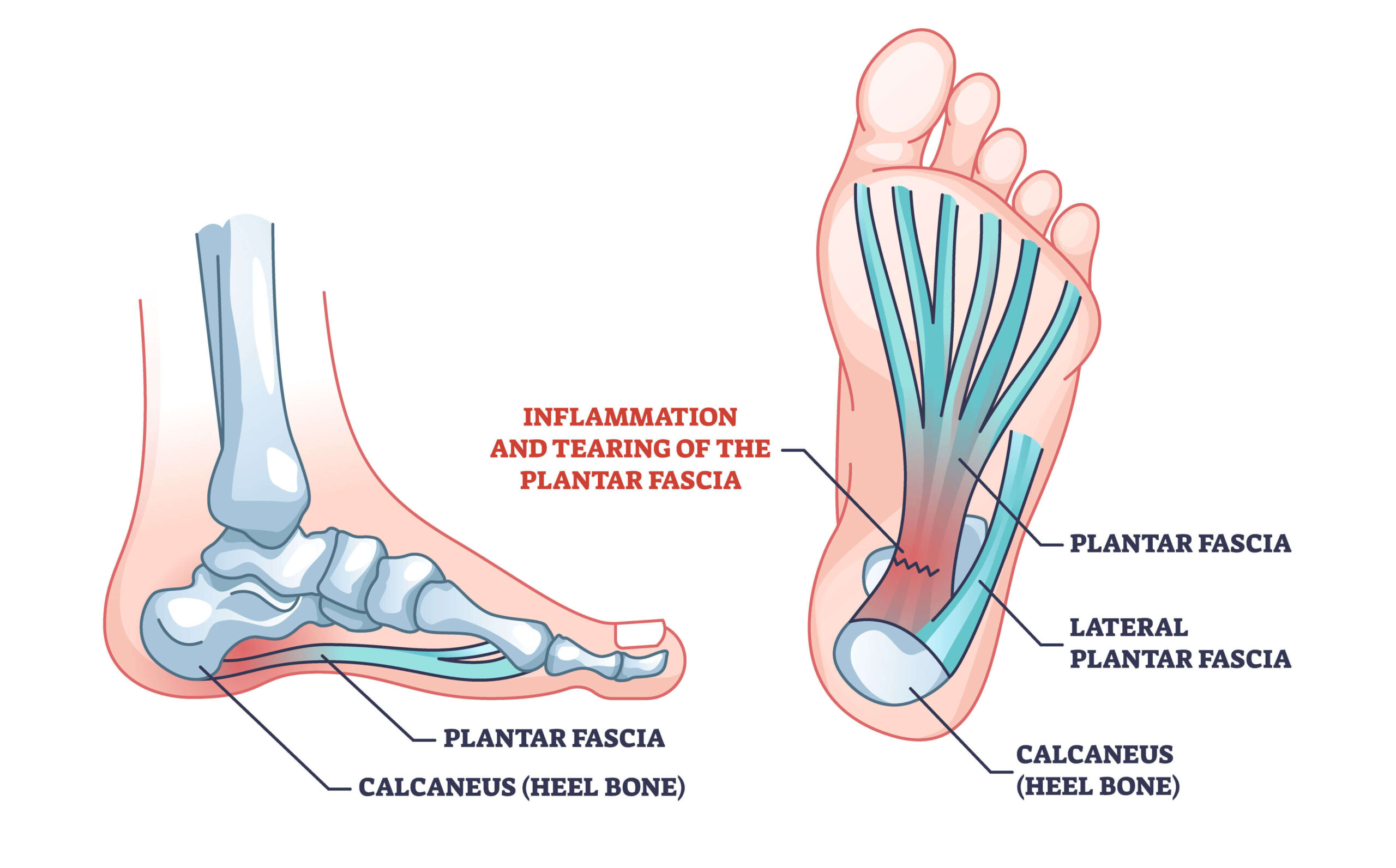 Plantar Fascia Tear