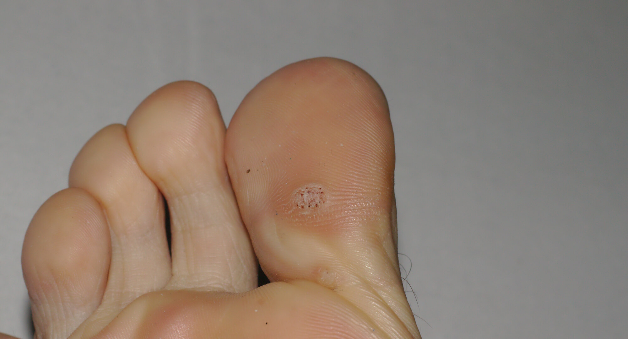 Plantar Wart