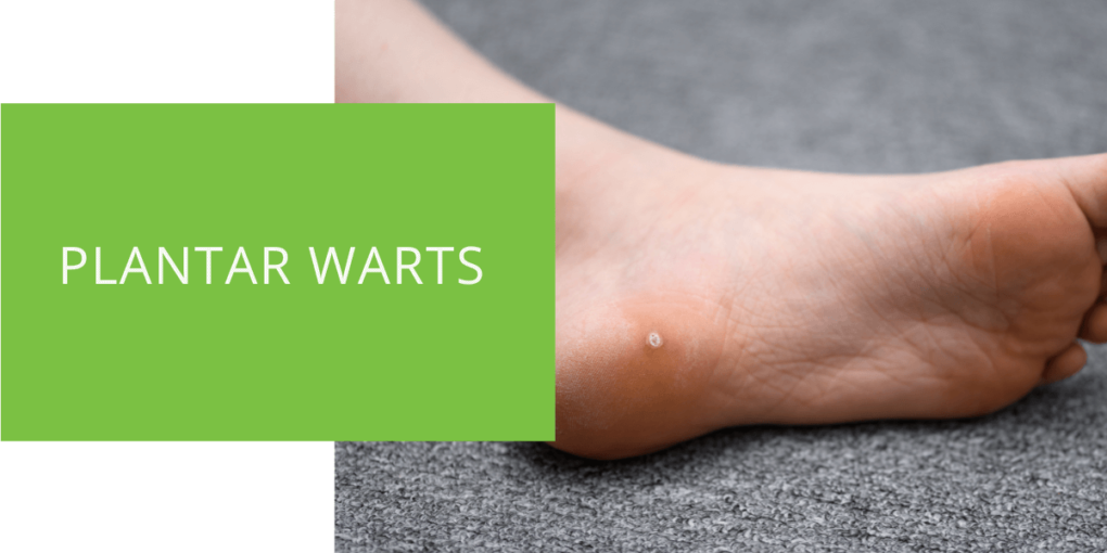 Plantar Warts