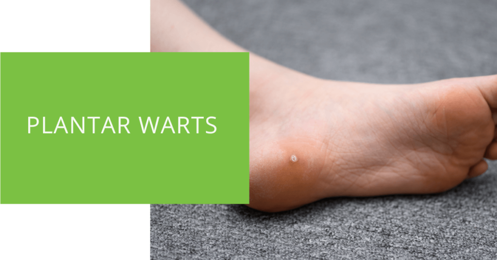 Plantar Warts