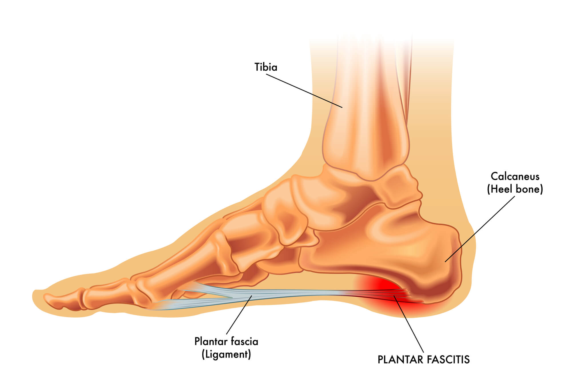 Plantar fasciitis illustration