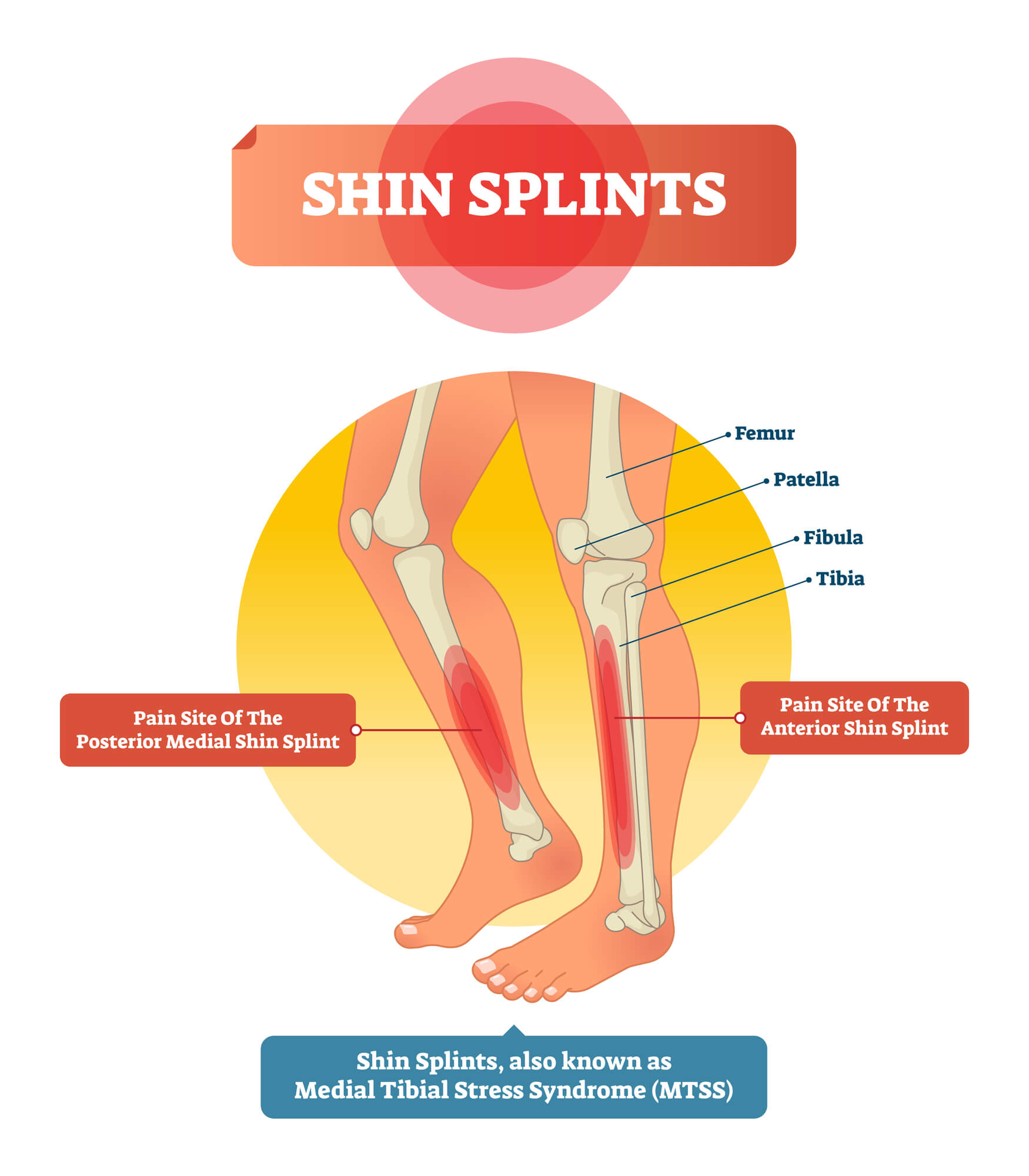 Shin Splints Illustration