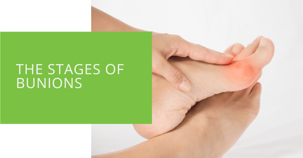 The Stages of Bunions