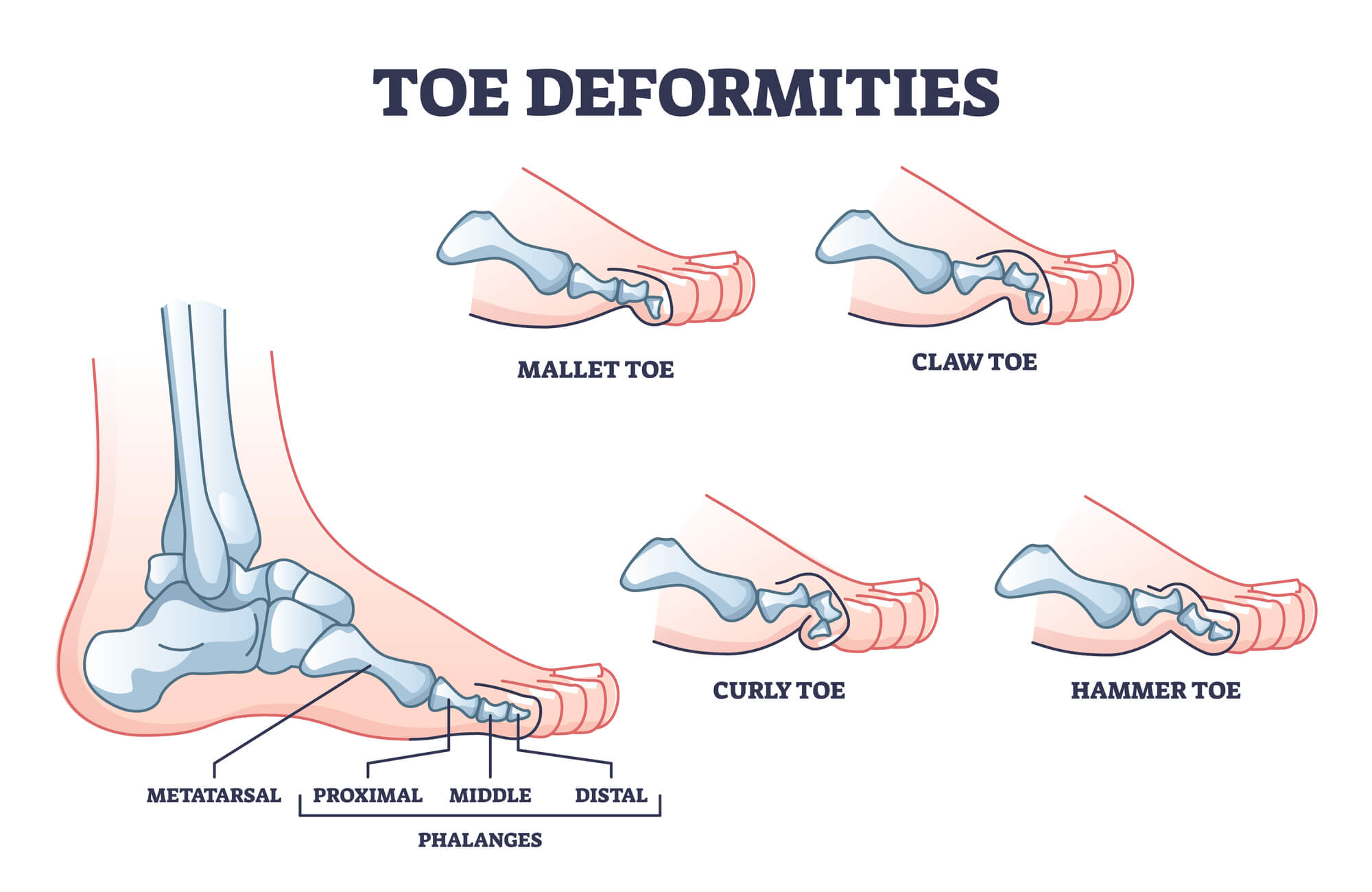 Toe Deformities