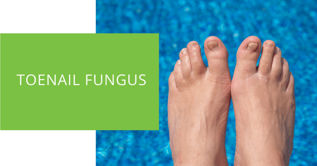 Toenail Fungus