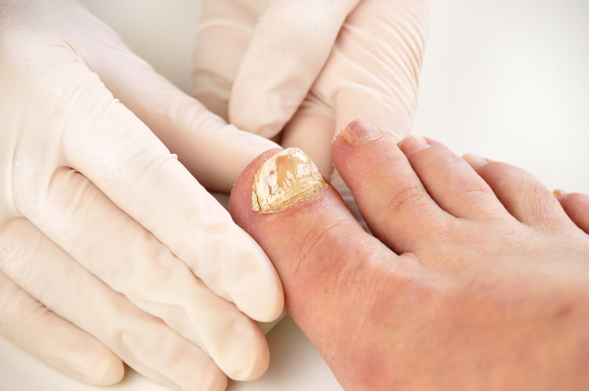 Toenail Fungus on Big Toe