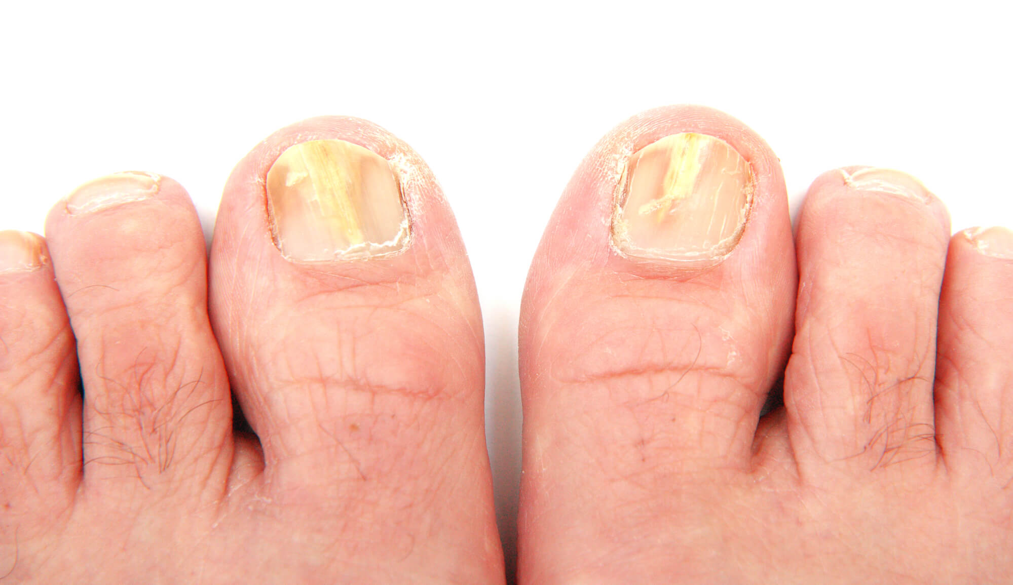 Toenails infected with a fungus
