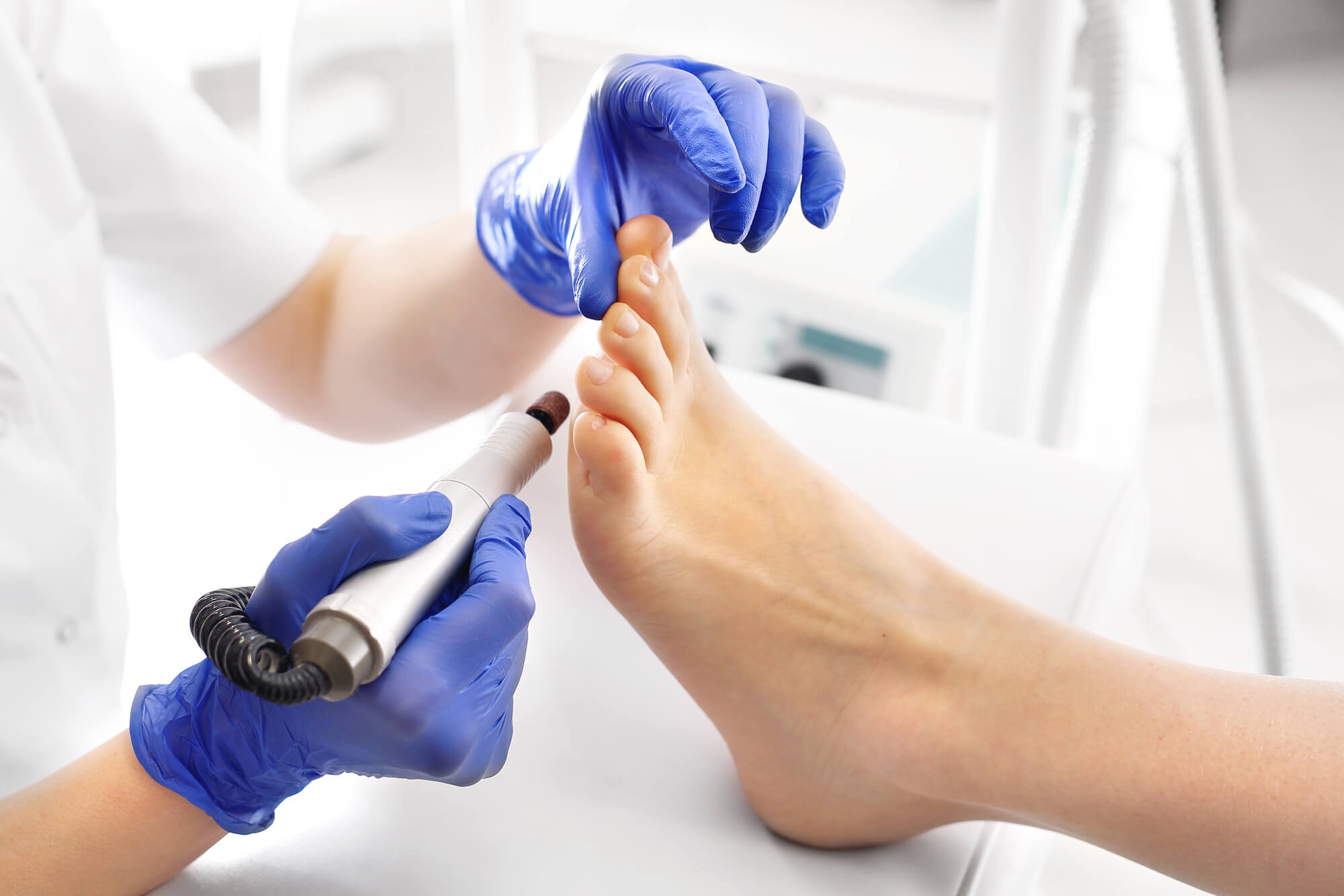 Treating Corns and Calluses