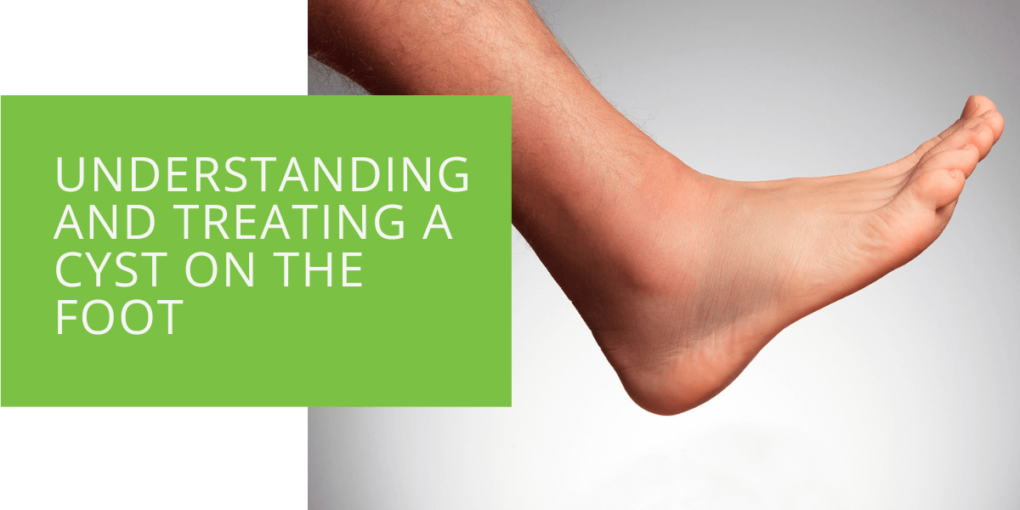 Understanding and Treating a Cyst on the Foot