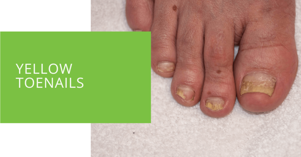 Yellow Toenails