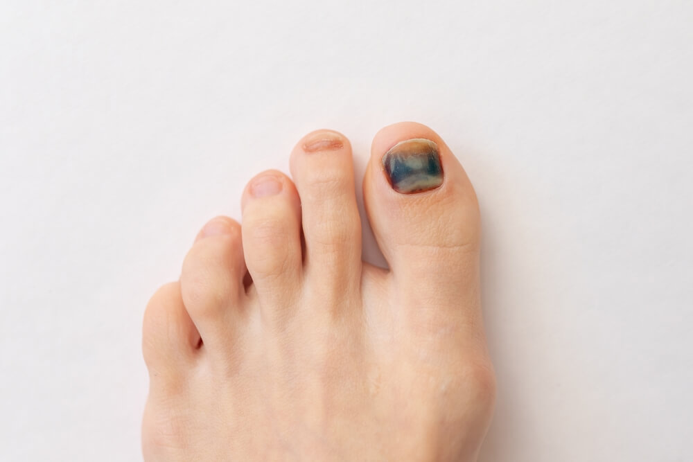 Black and Blue Toenail